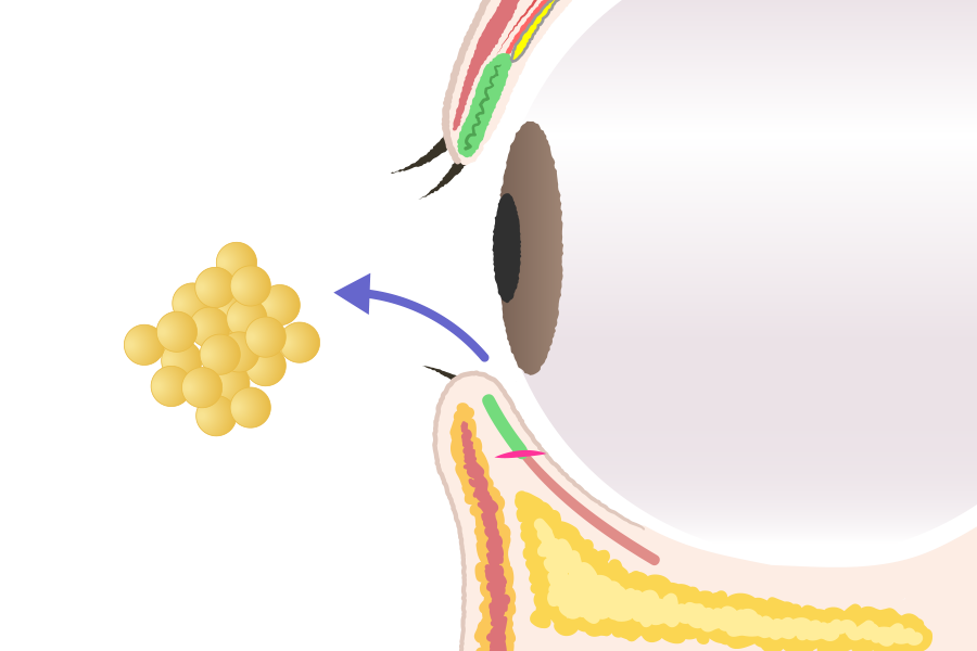 目の下の脂肪取りとは