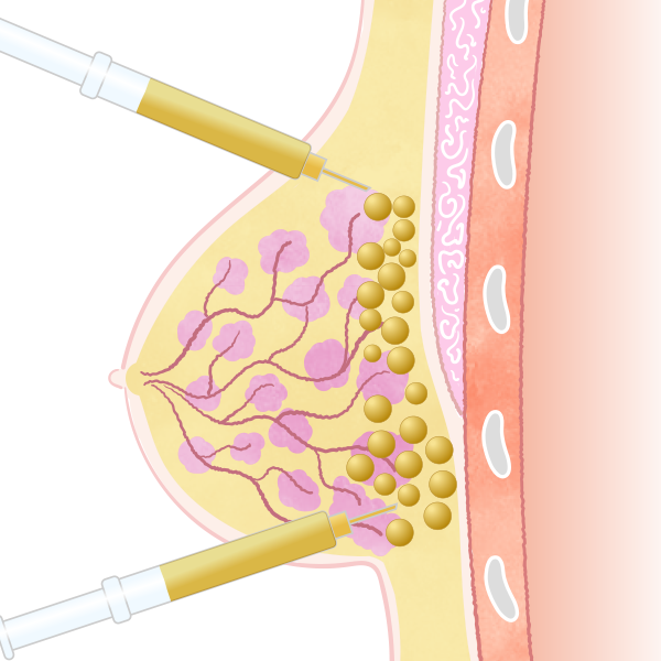 定着率・バストの形・痛みに配慮した注入技術