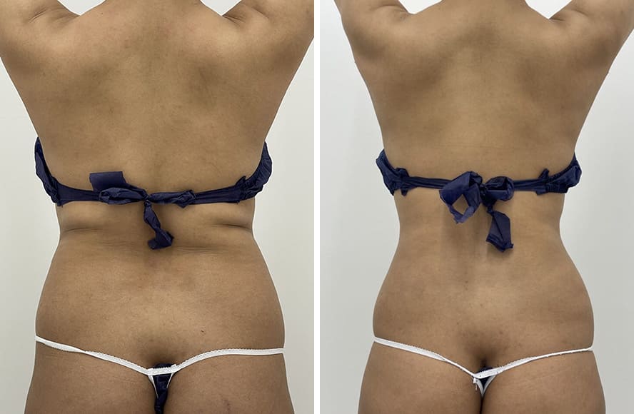 背中の脂肪吸引の症例写真