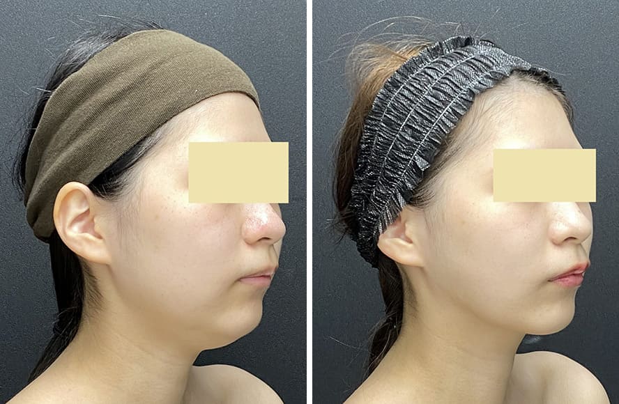 顔の脂肪吸引の症例写真