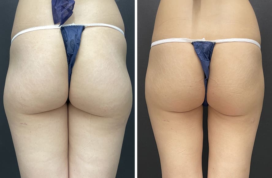 お尻の脂肪吸引の症例写真