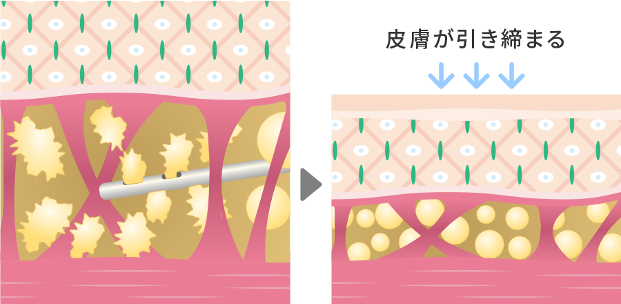 たるみ予防効果があり、皮膚がたれずに引き締まる